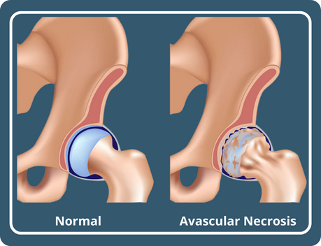 Symptoms and Treatment of Avascular Necrosis