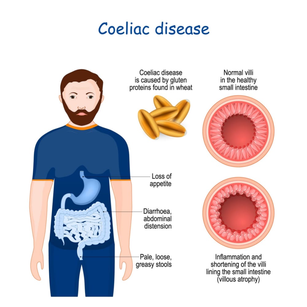Symptoms of Celiac Disease Symptoms of Celiac Disease