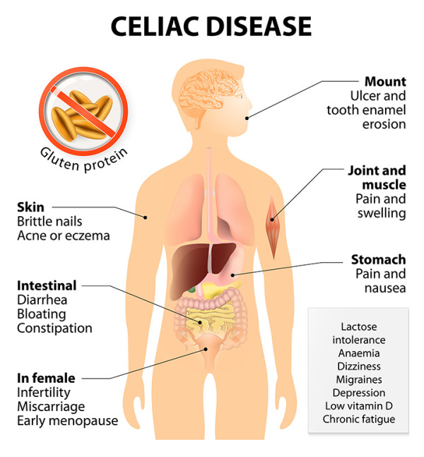Symptoms of Celiac Disease Symptoms of Celiac Disease