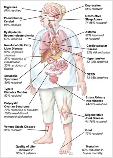 The Benefits of Bariatric Surgery
