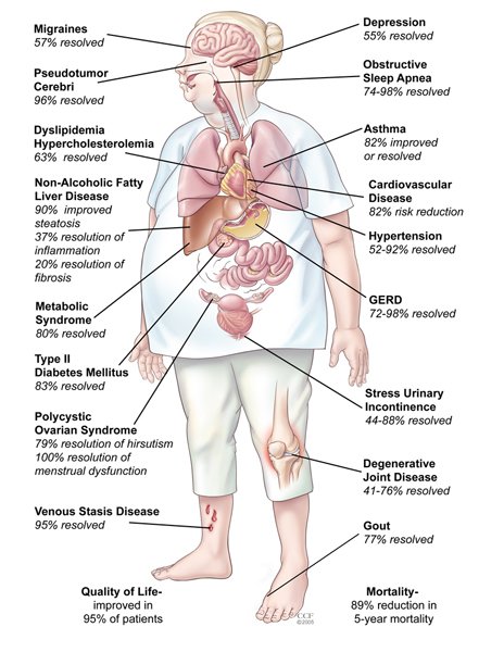 The Benefits of Bariatric Surgery