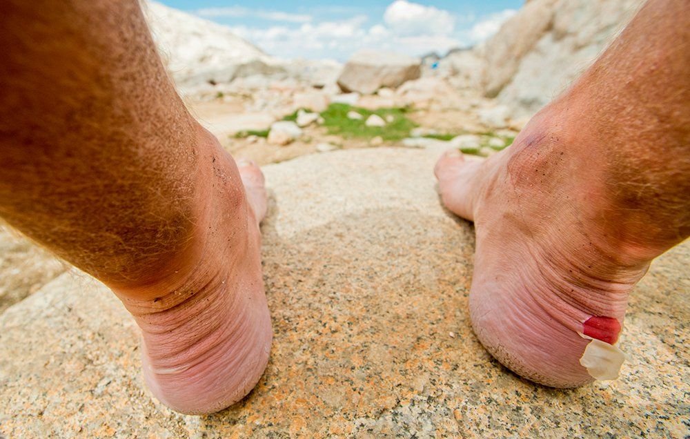 The Best Ways to Heal Blisters Quickly