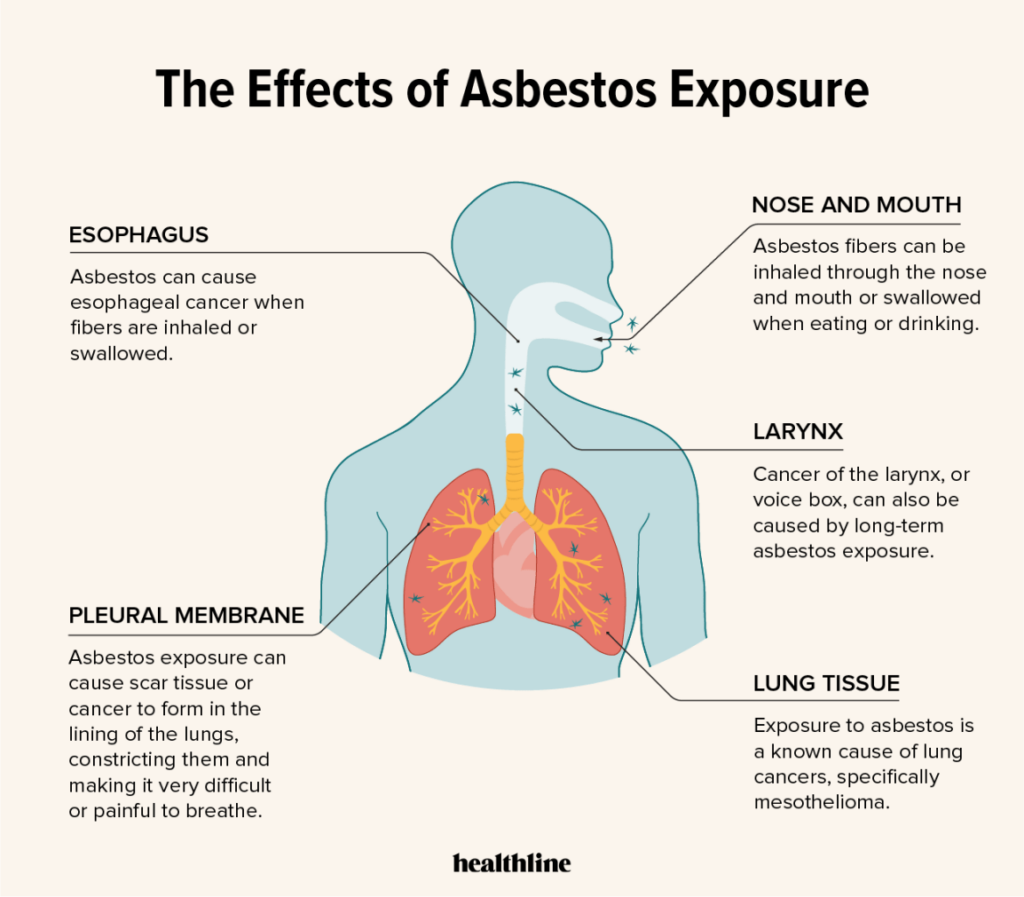 The Dangers of Asbestosis: Are You at Risk?