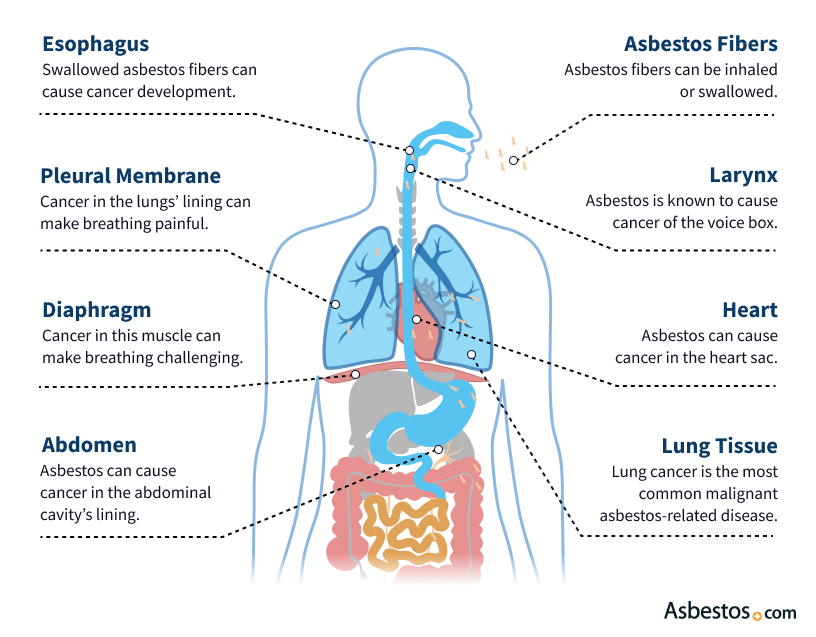 The Dangers of Asbestosis: Are You at Risk?