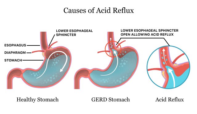 The Effects of Acid Reflux on Your Digestive System