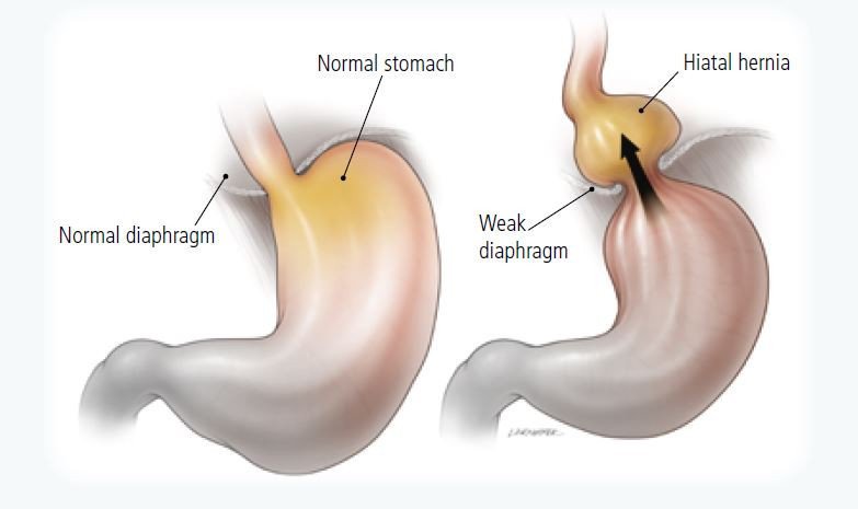 The Effects of Acid Reflux on Your Digestive System