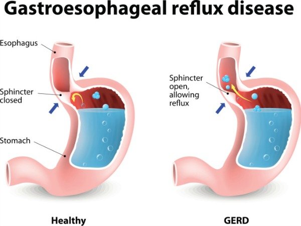 The Effects of Acid Reflux on Your Digestive System
