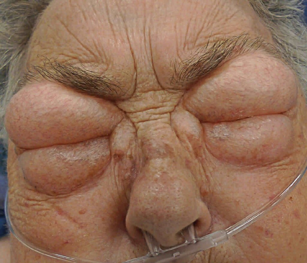 The Hidden Dangers of Angioedema: Identifying Risks and Preventive Measures