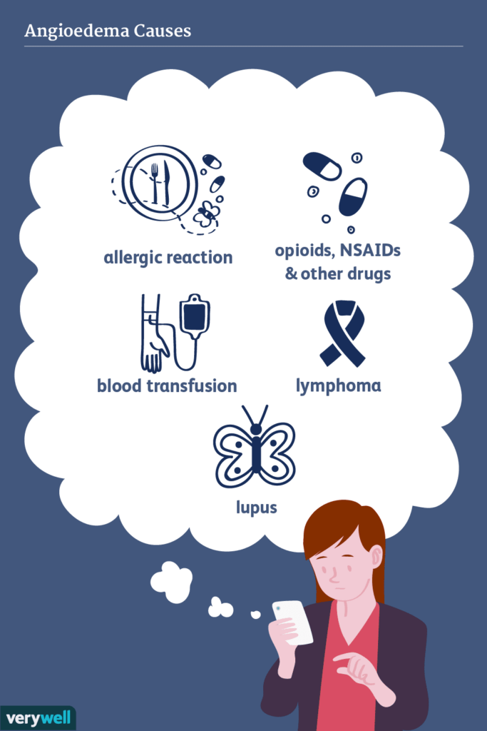 The Hidden Dangers of Angioedema: Identifying Risks and Preventive Measures