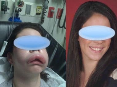 The Hidden Dangers of Angioedema: Identifying Risks and Preventive Measures