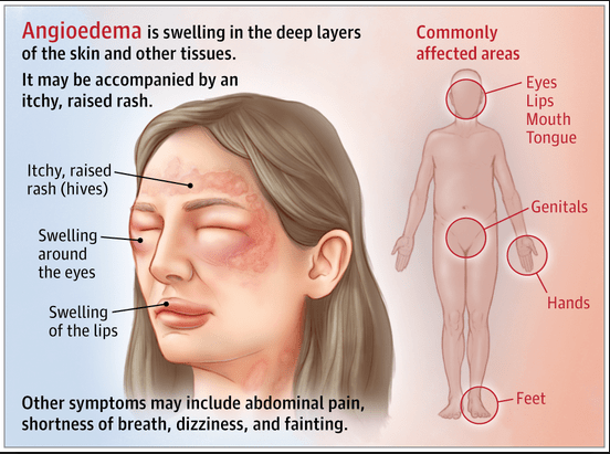 The Hidden Dangers of Angioedema: Identifying Risks and Preventive Measures