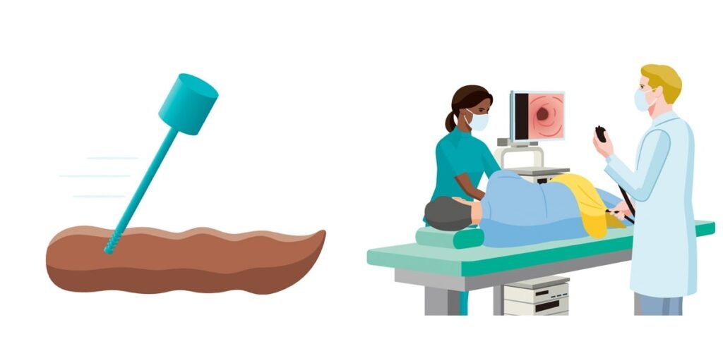 The Importance of Early Detection for Bowel Cancer