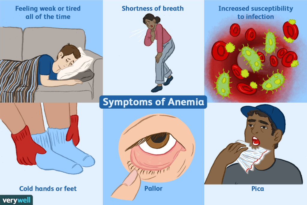 The Link Between Anemia and Fatigue