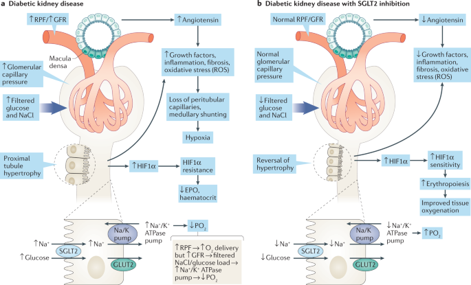 The Link Between Diabetes and Acute Renal Failure The Link Between Diabetes and Acute Renal Failure