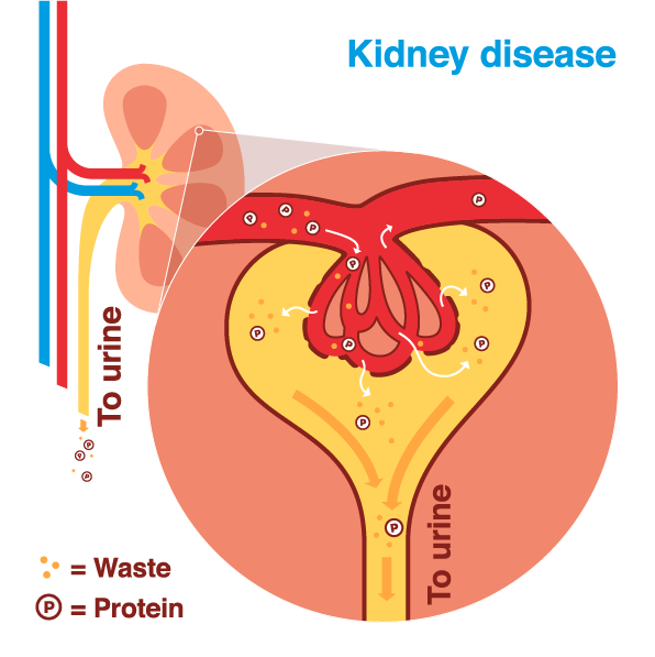 The Link Between Diabetes and Acute Renal Failure The Link Between Diabetes and Acute Renal Failure