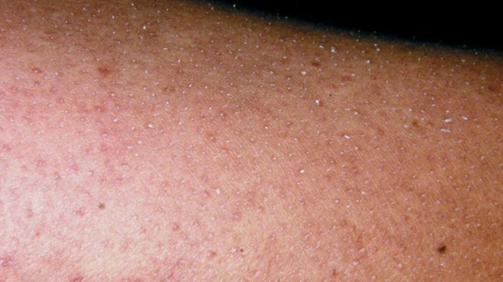 The Link Between Diet and Keratosis Pilaris: What to Eat and Avoid