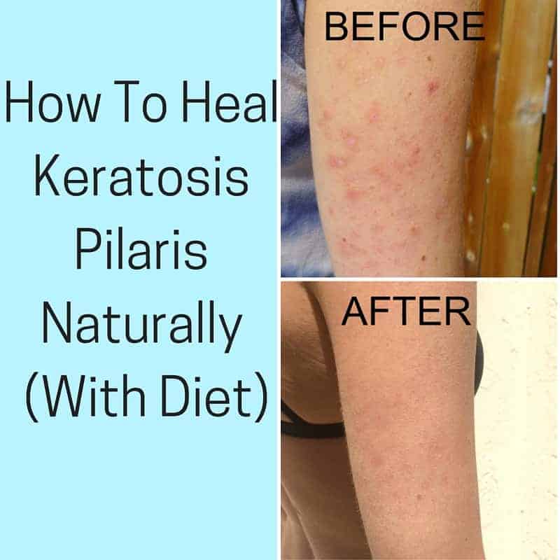 The Link Between Diet and Keratosis Pilaris: What to Eat and Avoid