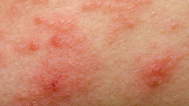 The Link between Eczema and Allergies: What You Need to Know