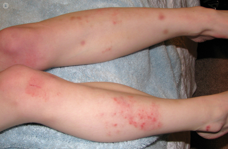 The Link between Eczema and Allergies: What You Need to Know