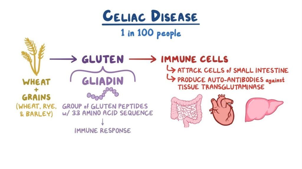 The Link Between Gluten and Celiac Disease