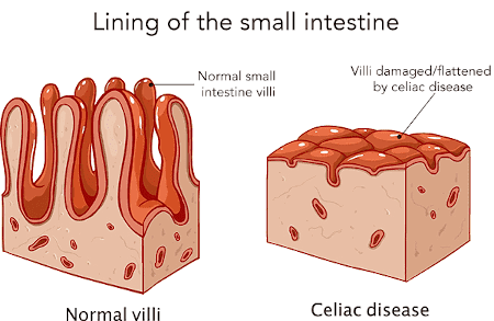The Link Between Gluten and Celiac Disease