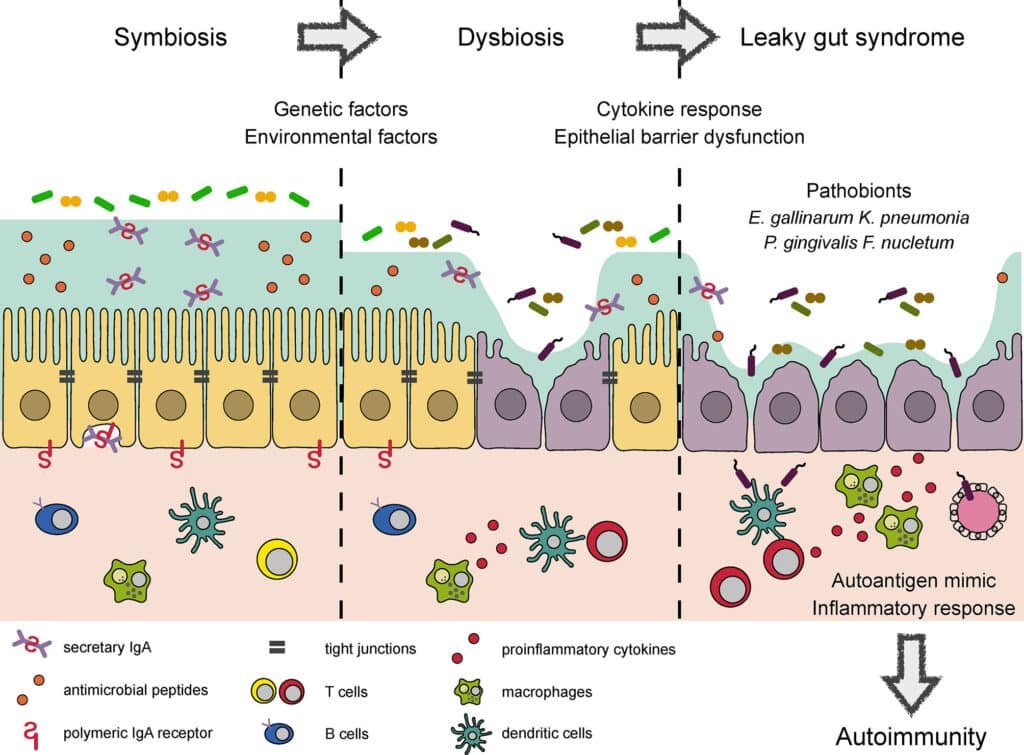 The Link Between Leaky Gut Syndrome and Autoimmune Diseases