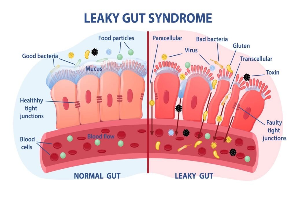 The Link Between Leaky Gut Syndrome and Autoimmune Diseases