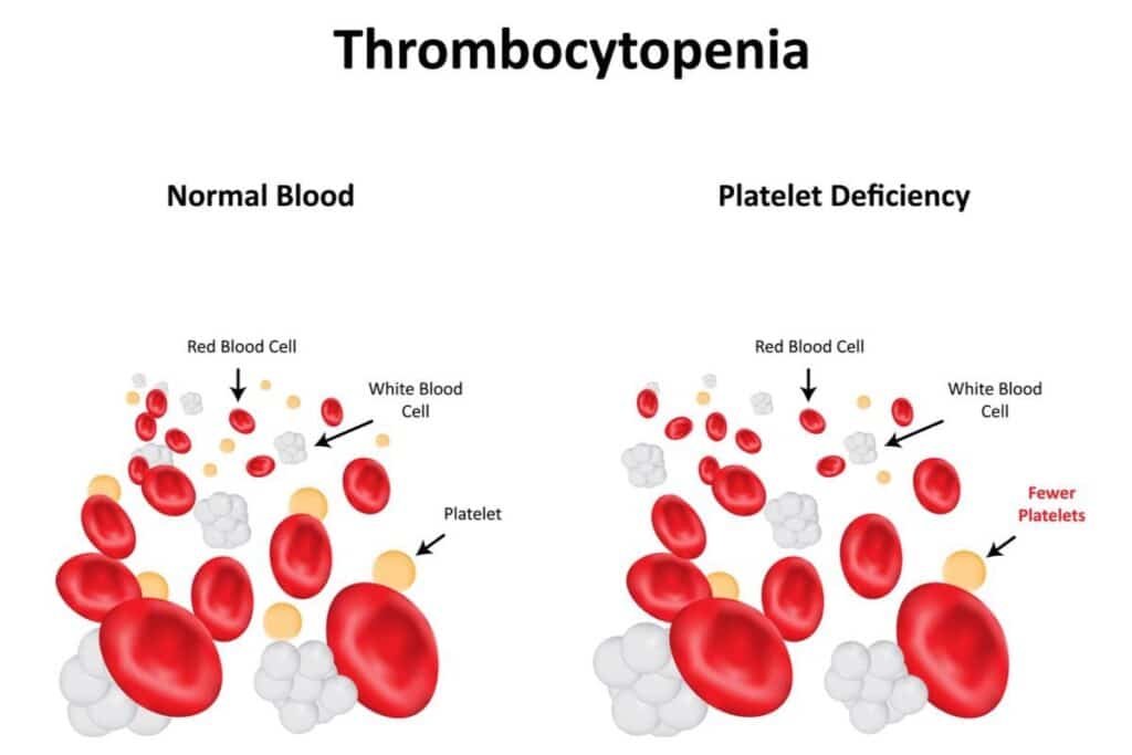 The Link Between Low Blood Platelets and Certain Medical Conditions