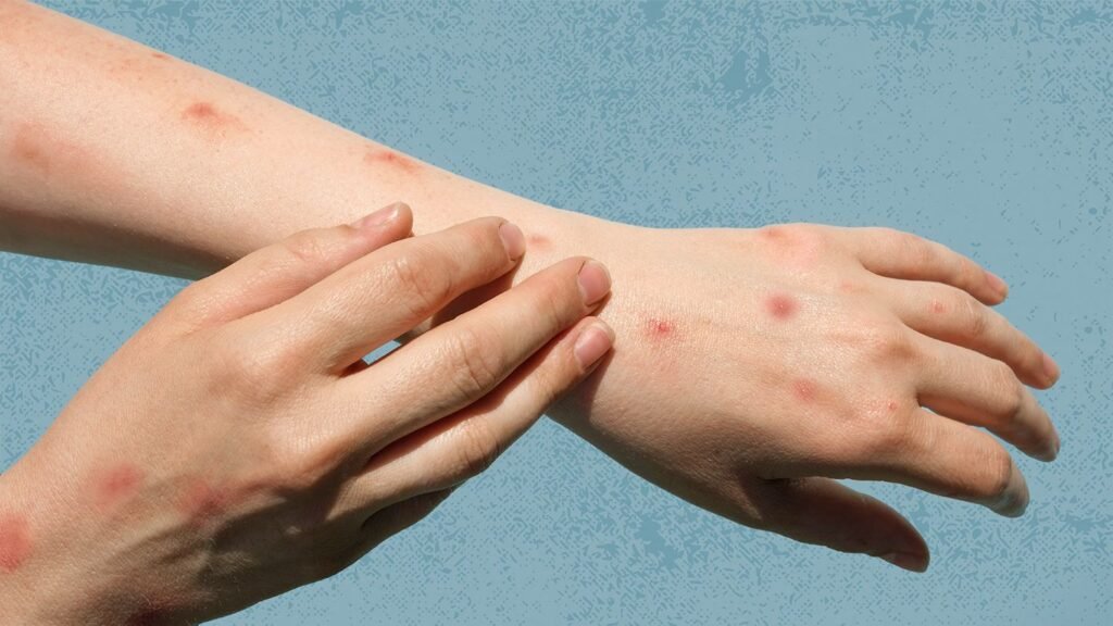 The Mystery of Mpox: Unraveling the Origins of Monkeypox