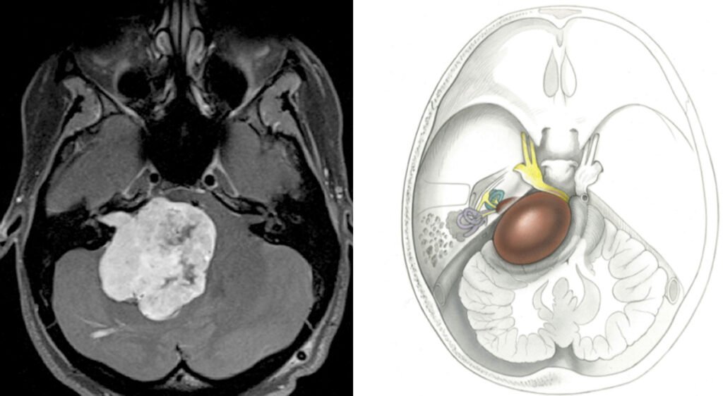 The Role of Genetics in Acoustic Neuroma Development