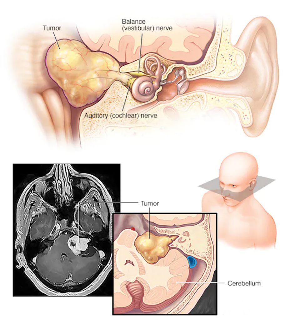 The Role of Genetics in Acoustic Neuroma Development