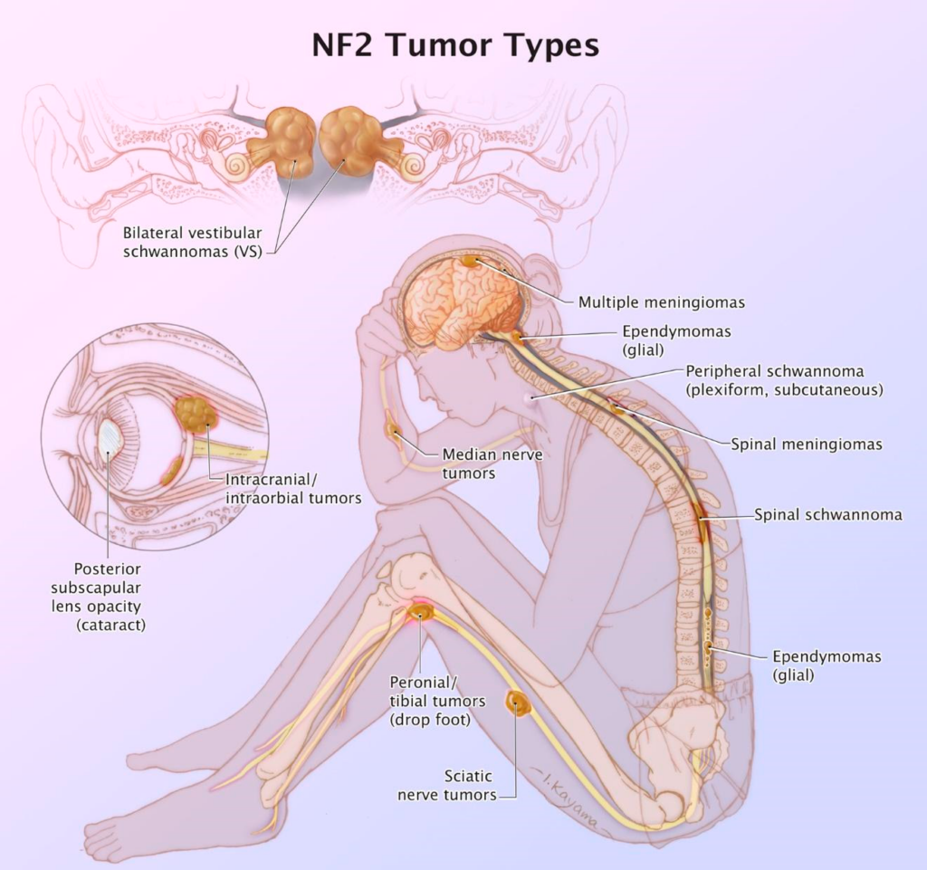 The Role of Genetics in Acoustic Neuroma Development