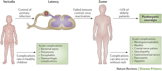 The Role of Zoster-Herpes Virus in Postherpetic Neuralgia
