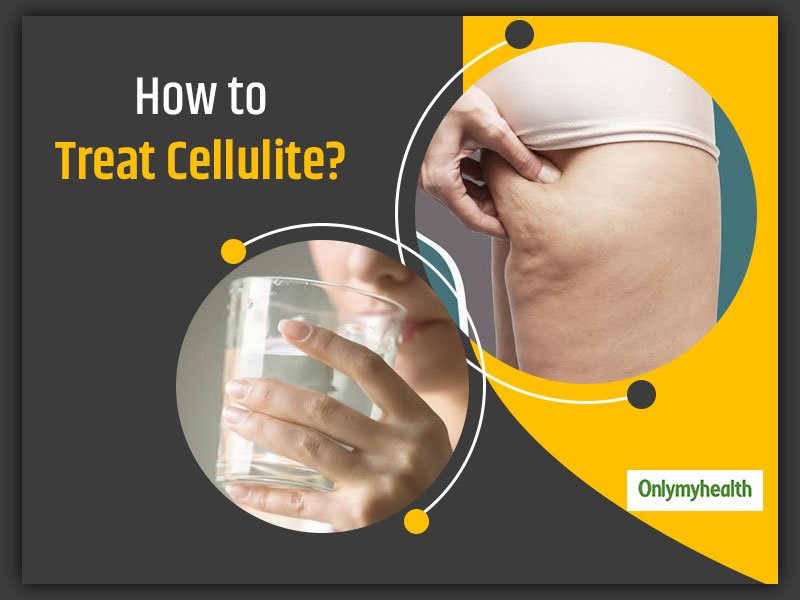 The Truth About Cellulite and How to Get Rid of It
