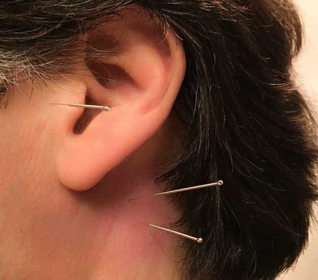 Tinnitus Treatment Acupuncture
