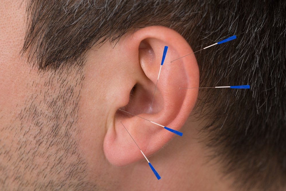 Tinnitus Treatment Acupuncture