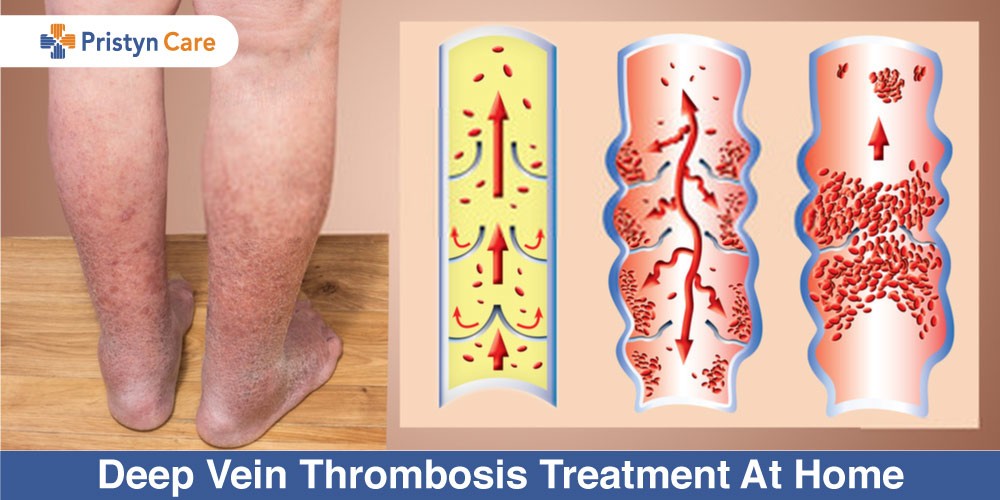 Treating Deep Vein Thrombosis Treating Deep Vein Thrombosis