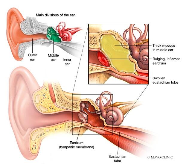 Treating Ear Infections