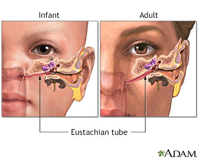 Treating Ear Infections
