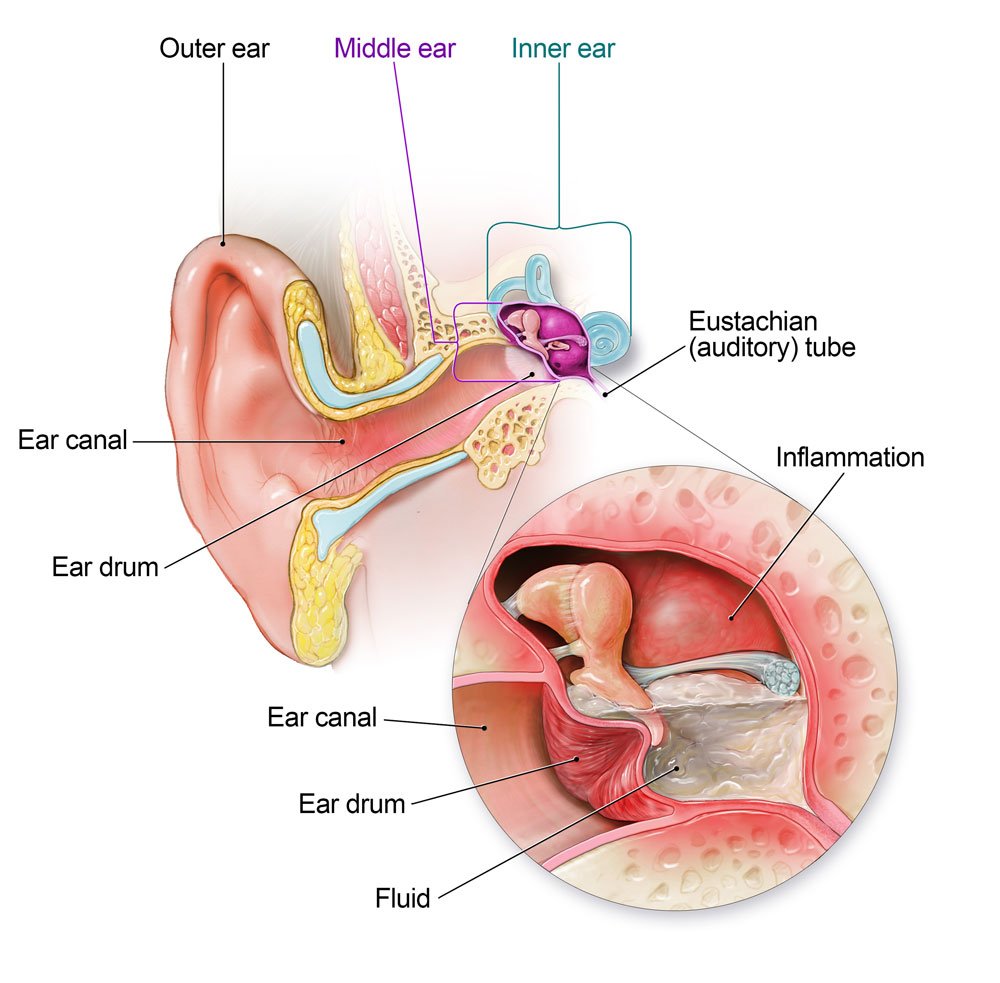 Treating Ear Infections