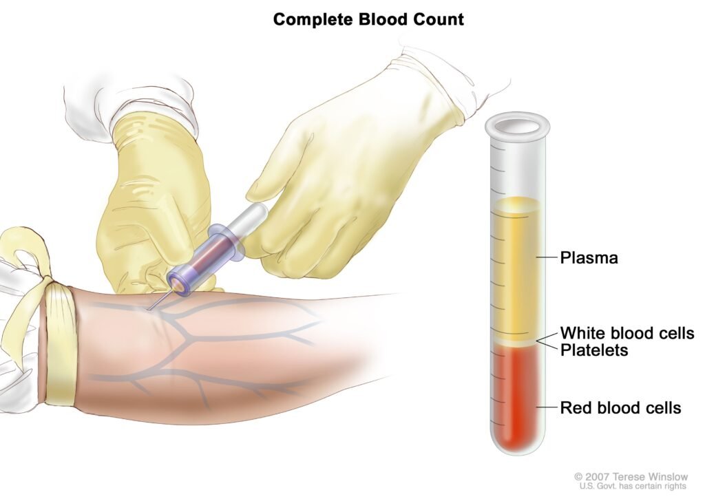 Treatment Options for Acute Myeloid Leukemia in Children