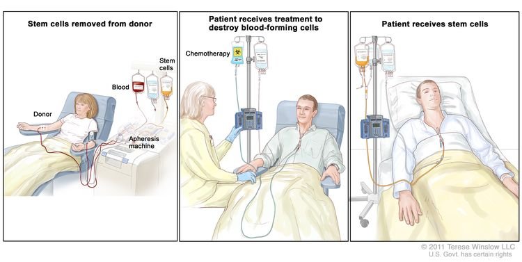 Treatment Options for Acute Myeloid Leukemia in Children