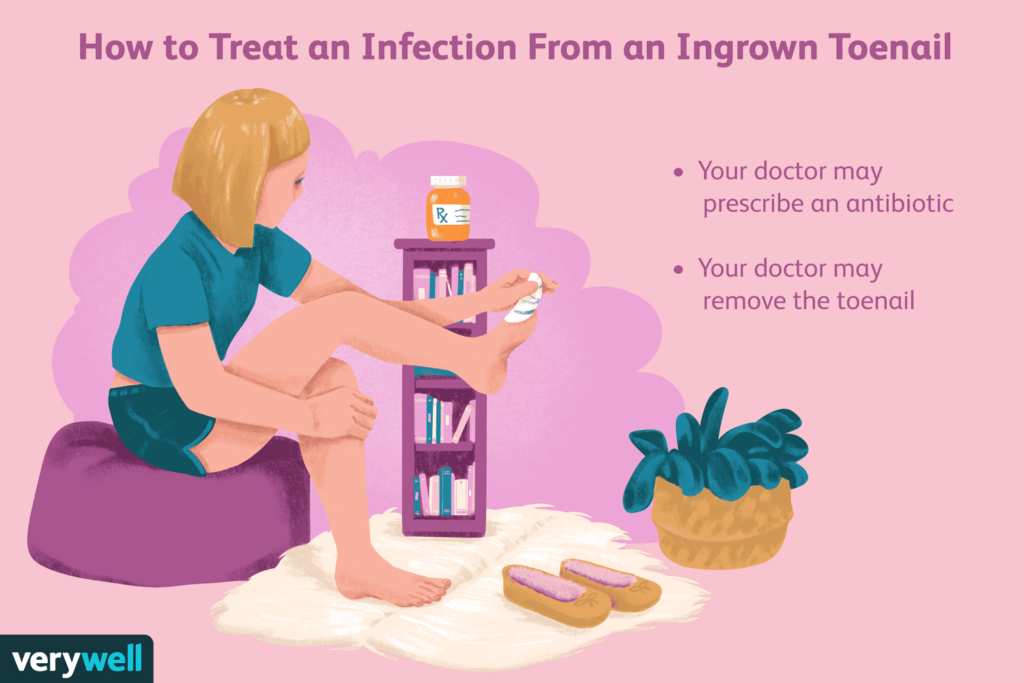 Treatment Options for an Ingrown Toenail