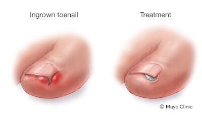 Treatment Options for an Ingrown Toenail