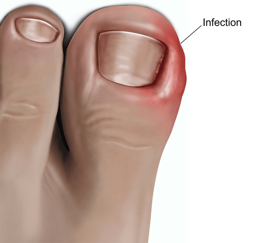 Treatment Options for an Ingrown Toenail