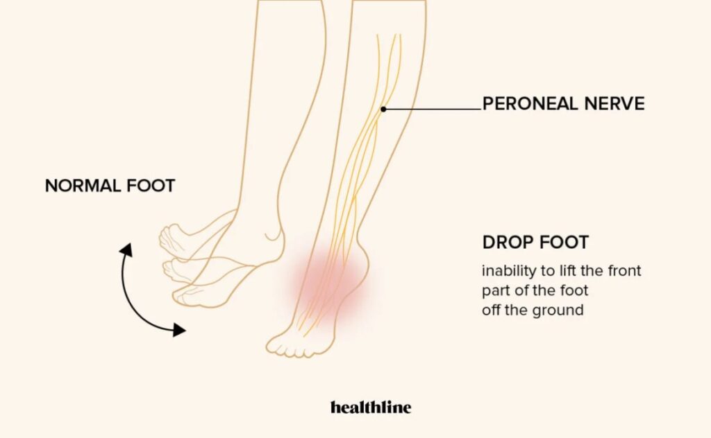 Treatment Options for Foot Drop