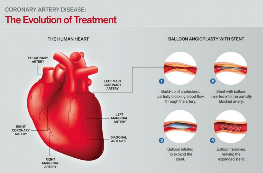 Treatment Options for Heart Disease