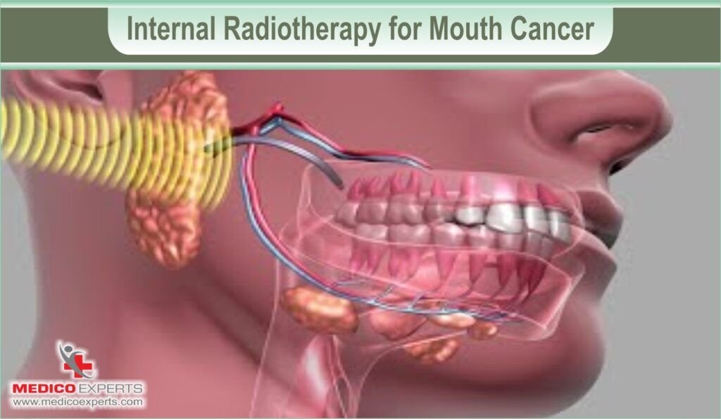 Treatment Options for Mouth Cancer