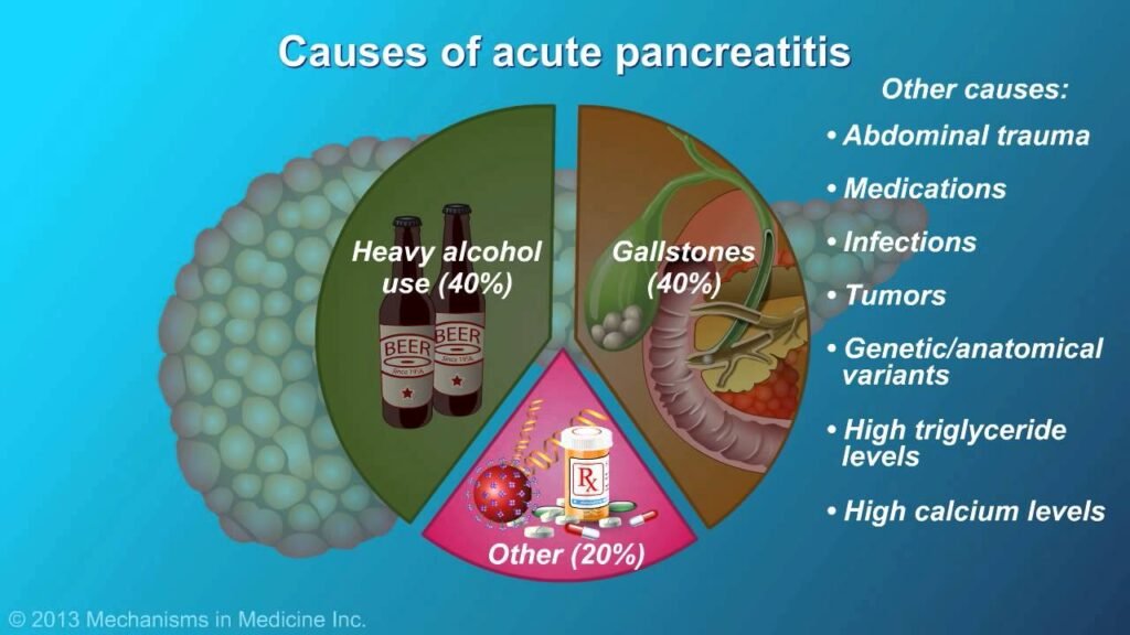 Understanding Acute Pancreatitis: Causes, Symptoms, and Treatment