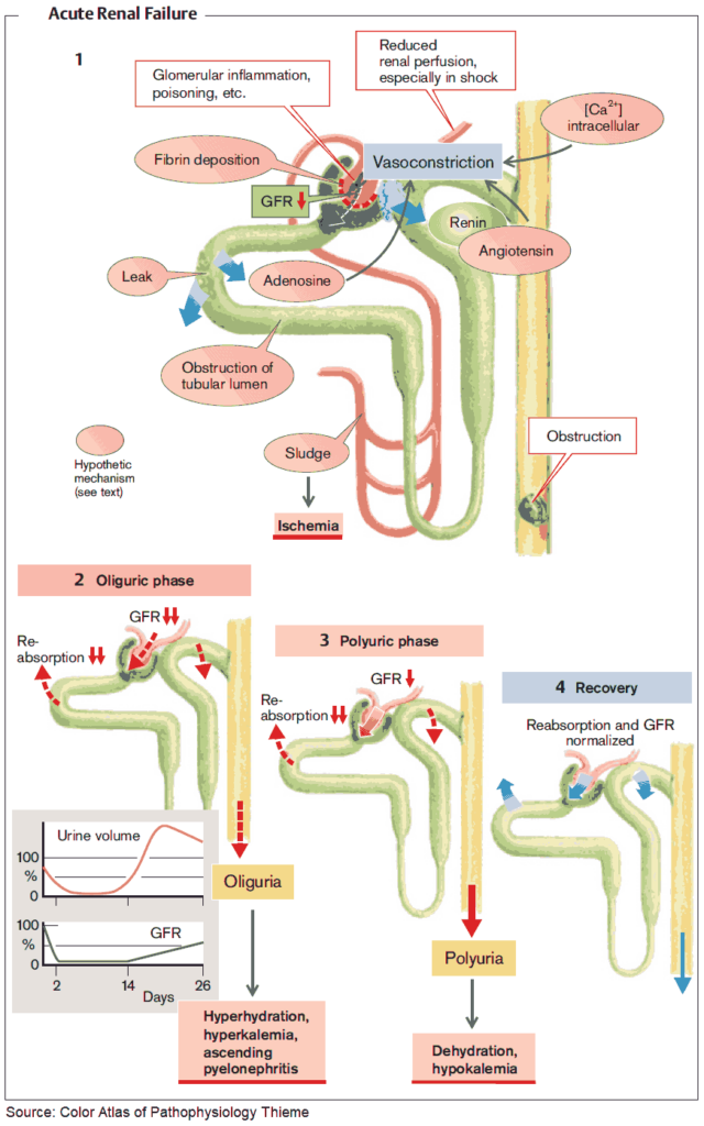 Understanding Acute Renal Failure: Causes, Symptoms, and Treatment Understanding Acute Renal Failure: Causes, Symptoms, and Treatment